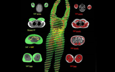 La Densitometria DEXA: un metodo di validazione adatto per i dispositivi BIA?